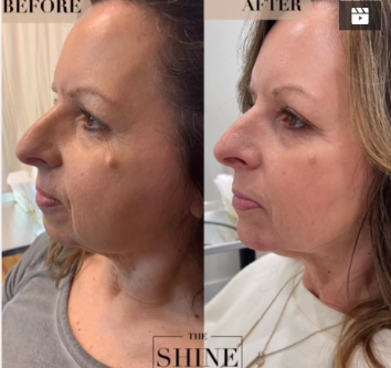 Before and After Medspa Treatment Photo | The Shine Spa in Clayton, MO