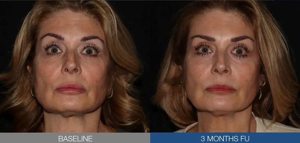 Sofwave® Before & After 1