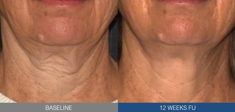 Sofwave® Before & After 2