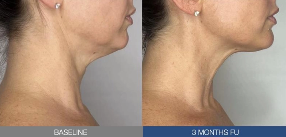 Sofwave® Before & After 3